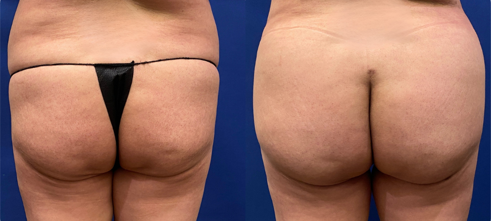 brazilian butt lift before and after photo by john m compoginis md facs in newport beach ca