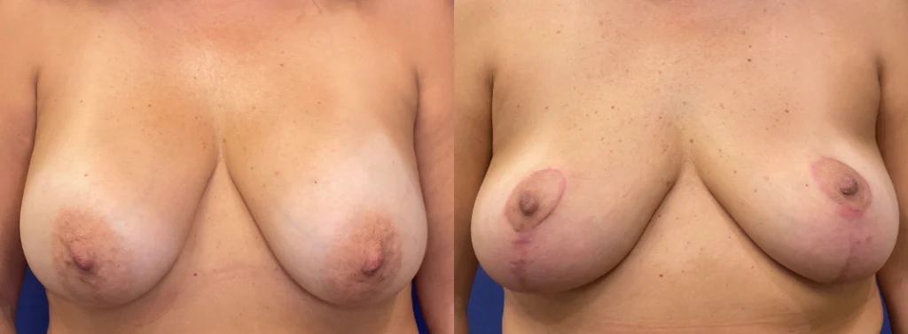 breast lift before and after photo by john m compoginis md facs in newport beach ca