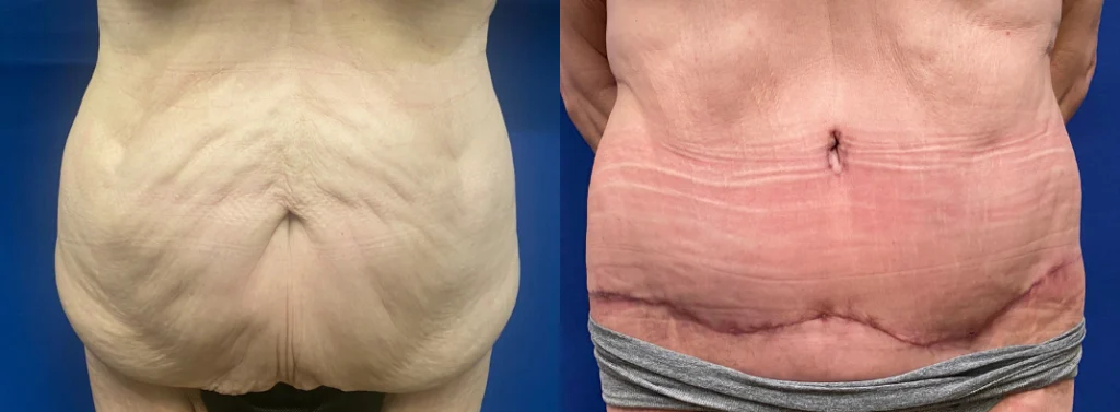 tummy tuck before and after photo by john m compoginis md facs in newport beach ca