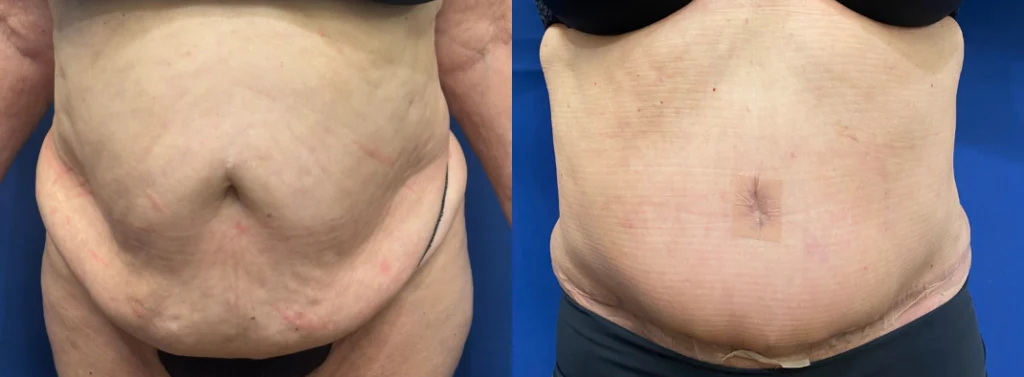 tummy tuck before and after photo by john m compoginis md facs in newport beach ca