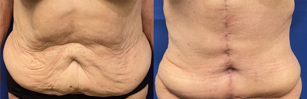 tummy tuck before and after photo by john m compoginis md facs in newport beach ca