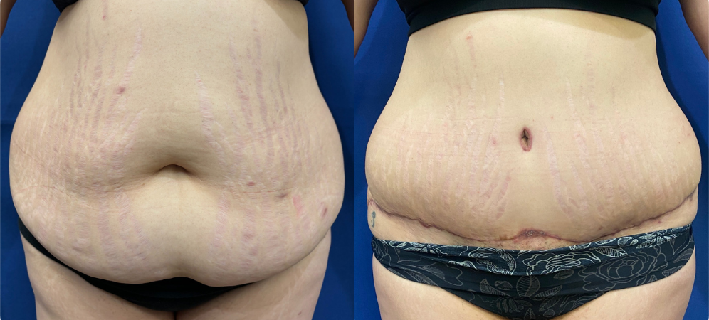 tummy tuck before and after photo by john m compoginis md facs in newport beach ca