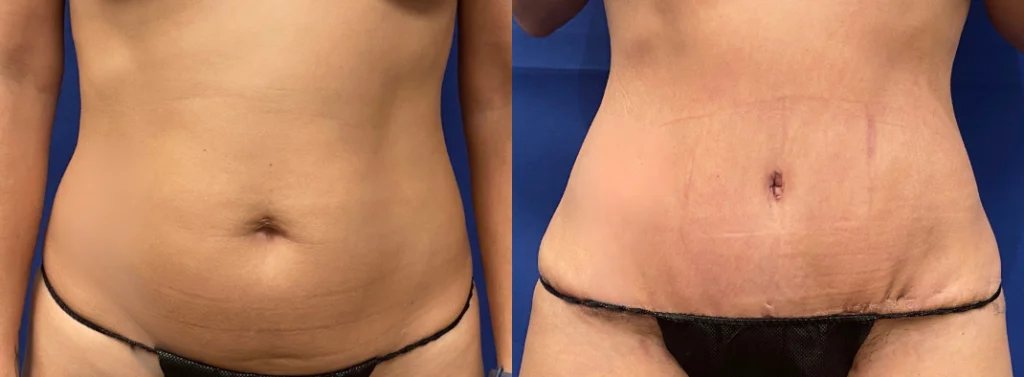 tummy tuck before and after photo by john m compoginis md facs in newport beach ca