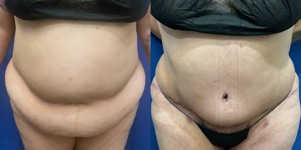 tummy tuck before and after photo by john m compoginis md facs in newport beach ca