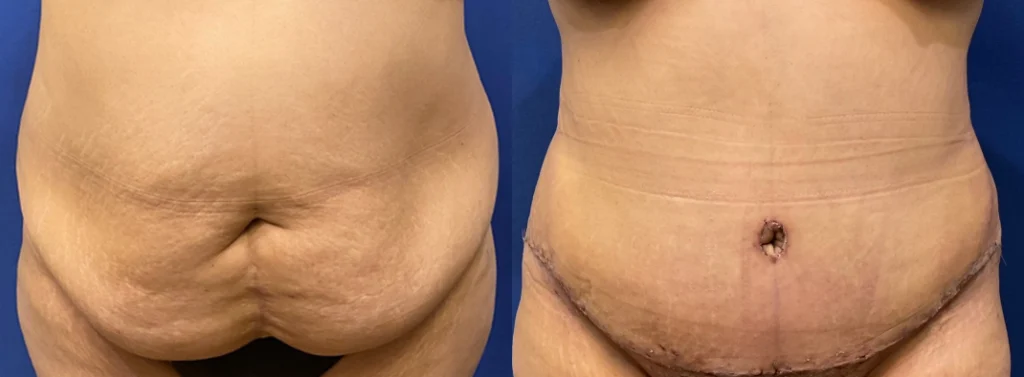 tummy tuck before and after photo by john m compoginis md facs in newport beach ca