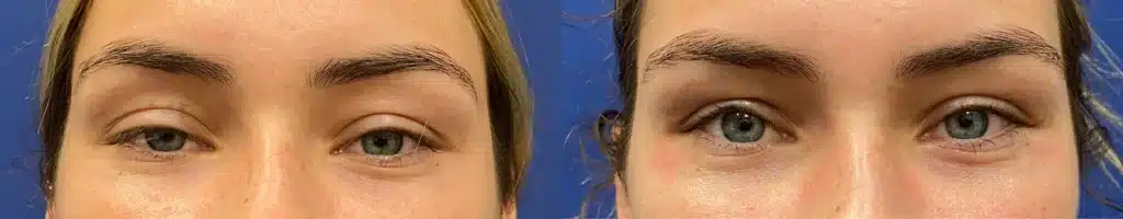 blepharoplasty before and after photo by john m compoginis md facs in newport beach ca