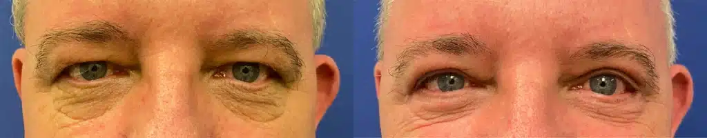 blepharoplasty before and after photo by john m compoginis md facs in newport beach ca