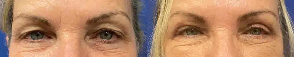 blepharoplasty before and after photo by john m compoginis md facs in newport beach ca