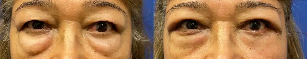 blepharoplasty before and after photo by john m compoginis md facs in newport beach ca