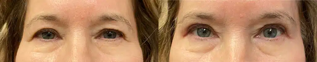 blepharoplasty before and after photo by john m compoginis md facs in newport beach ca