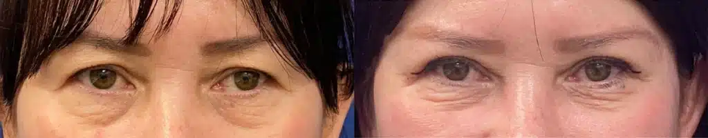 blepharoplasty before and after photo by john m compoginis md facs in newport beach ca