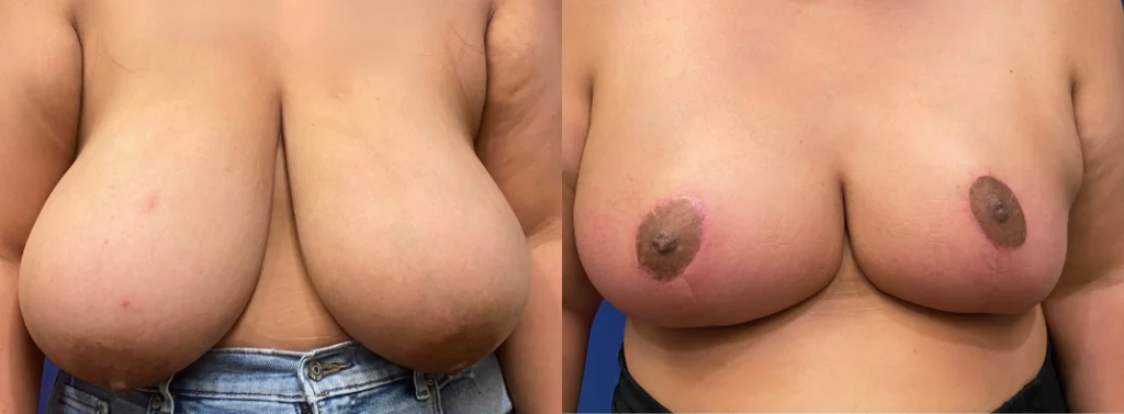 breast reduction before and after photo by john m compoginis md facs in newport beach ca
