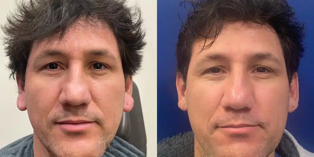 ear procedures before and after photo by john m compoginis md facs in newport beach ca