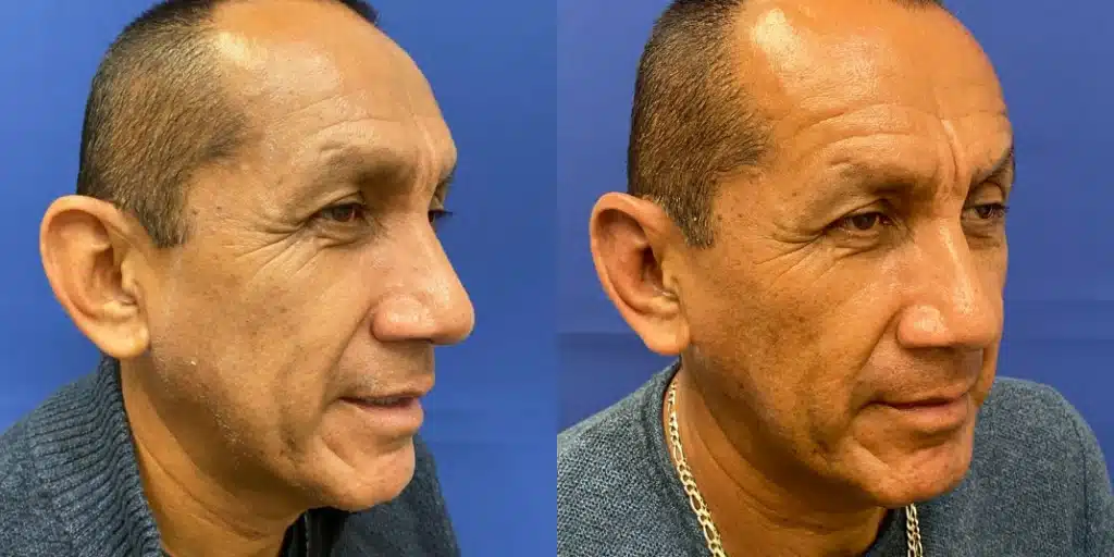 ear procedures before and after photo by john m compoginis md facs in newport beach ca